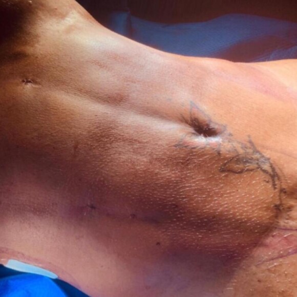 Gretchen aprovou o resultado da lipo de alta definição