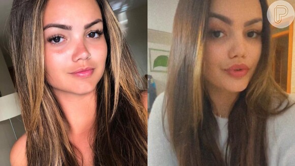 Veja antes e depois de Suzanna Freitas após preenchimento labial e botox na testa!