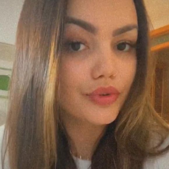 Veja antes e depois de Suzanna Freitas após preenchimento labial e botox na testa!