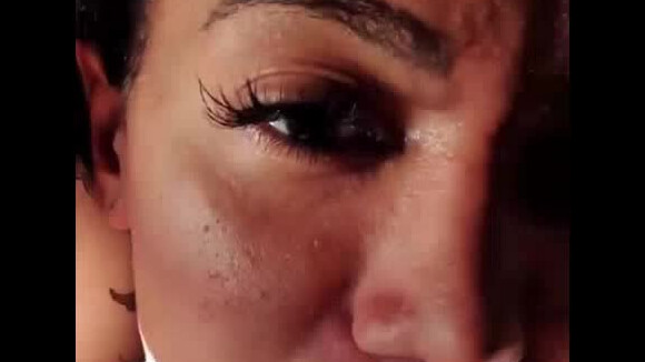 Anitta fala sobre espinhas no rosto