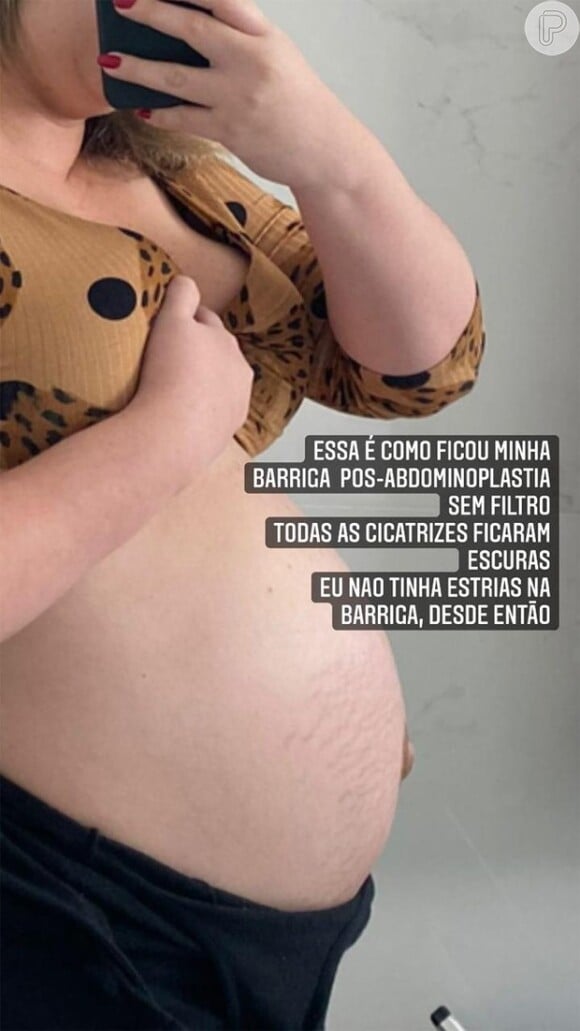 Marília Mendonça mostra como ficou sua barriga na gravidez e após o procedimento estético