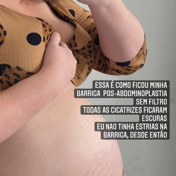 Marília Mendonça mostra como ficou sua barriga na gravidez e após o procedimento estético