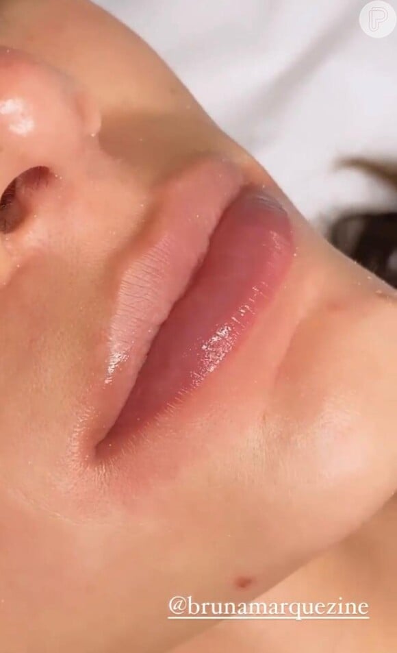 Bruna Marquezine exibe resultado de lábios iluminados e mais rejuvenescidos após técnica hidragloss