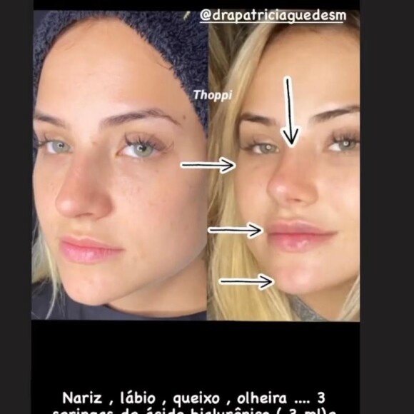 Gabi Martins fez harmonização facial com Tierry em janeiro de 2021 e exibiu o antes e depois nas redes sociais