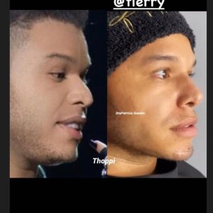 Tierry e o resultado da harmonização facial realizada com a namorada, Gabi Martins