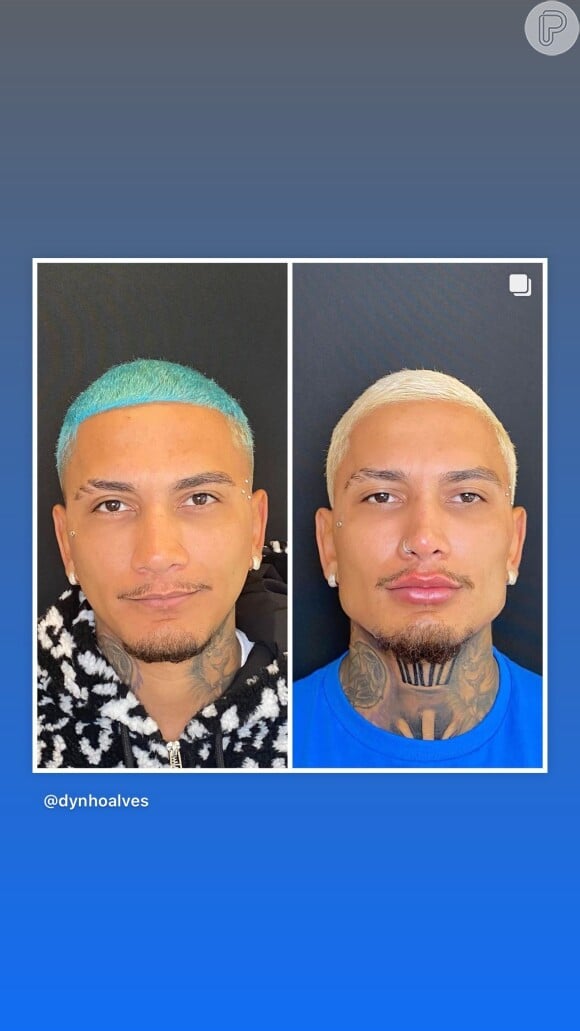 Dynho Alves antes e depois da harmonização facial
