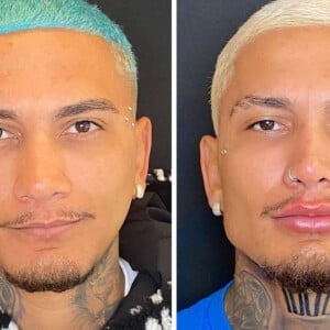 Dynho Alves antes e depois da harmonização facial