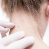 Dezembro Laranja: tratamentos estéticos podem agravar quadros de câncer de pele, alerta dermatologista