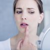 A herpes labial não tem cura, mas pode ser tratada para evitar lesões na boca