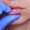 Herpes labial: um dos sintomas é o aparecimento de bolhas na boca