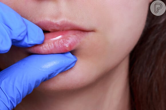 Herpes labial: um dos sintomas é o aparecimento de bolhas na boca