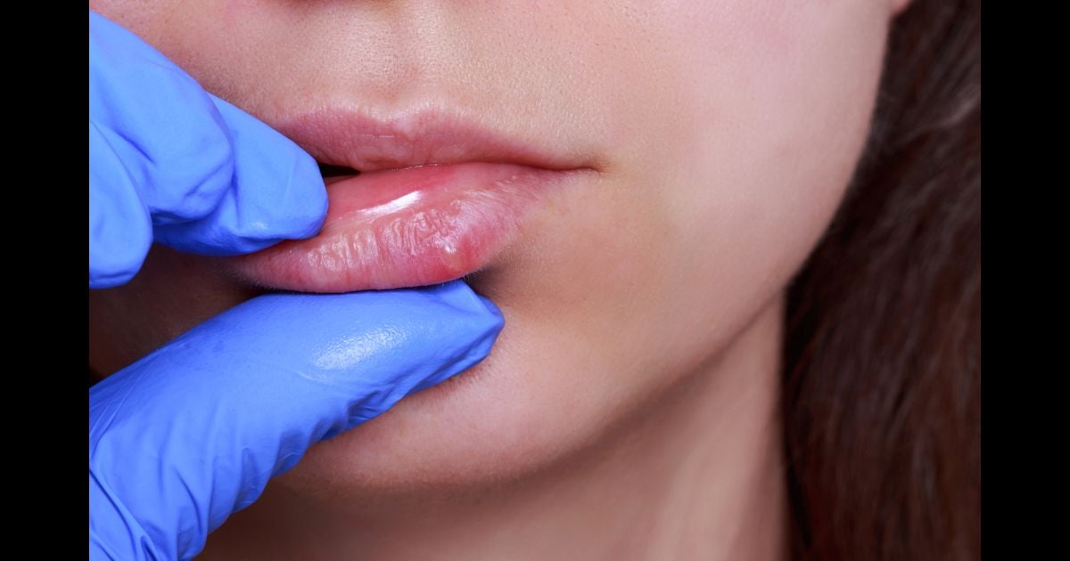 Herpes labial: um dos sintomas é o aparecimento de bolhas na boca ...