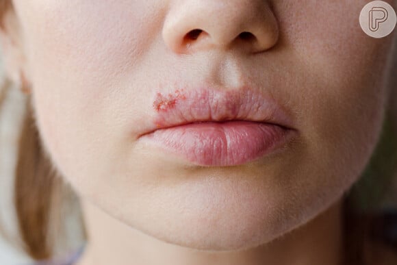 Os ferimentos da herpes labial precisam ser devidamente cuidados para uma melhor cicatrização