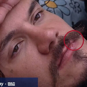 Eliezer está com herpes e isso foi bastante comentado fora do 'BBB 22'