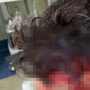 Thiago Rodrigues perdeu parte do couro cabeludo após espancamento