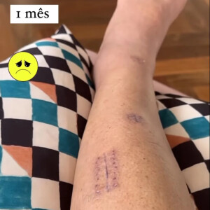 Luciana Gimenez mostrou os hematomas na perna