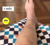 Após grave acidente, Luciana Gimenez mostrou como está a cicatrização da perna
