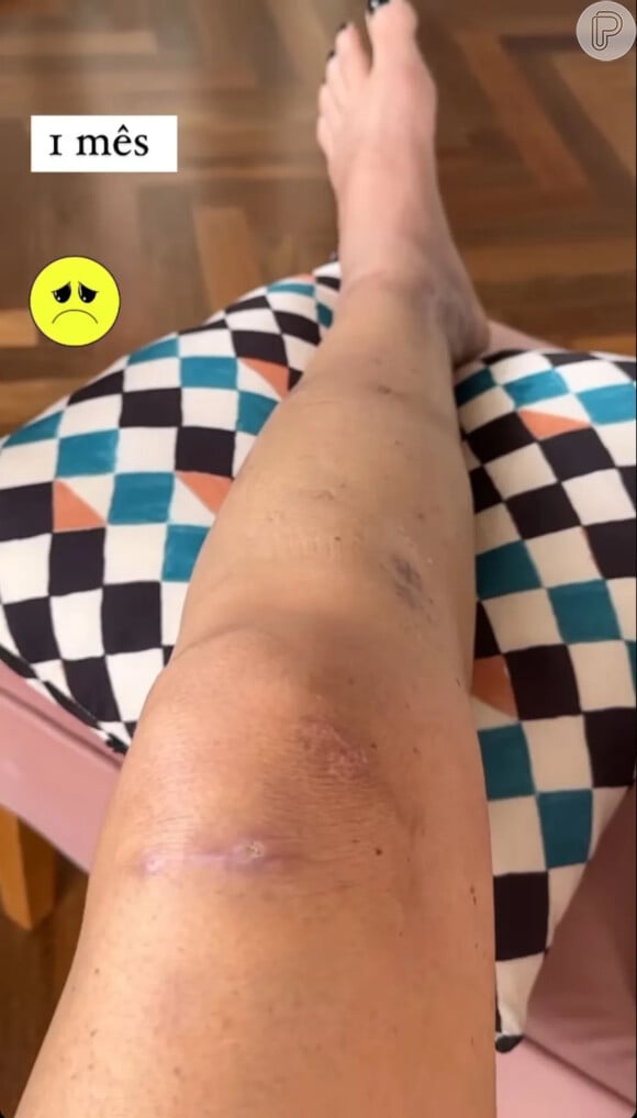 Após grave acidente, Luciana Gimenez mostrou como está a cicatrização da perna
