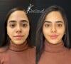 Mariely Santos, uma das Gêmeas da Lacração, fez harmonização facial