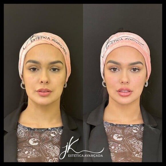 Larissa Santos fez hamornização facial e mostrou no seu Instagram o antes e o depois.