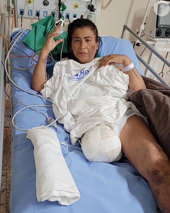 MC Katia precisou amputar a perna após uma trombose
