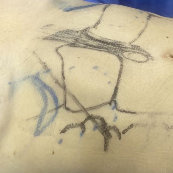 Sheila Mello passou por uma cirurgia para a retirada de uma hérnia e para reverter uma diástase abdominal