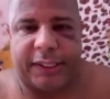 Marcelinho Carioca apareceu com o olho machucado após um aparente soco e diz que foi sequestrado após ter relação com uma mulher casada