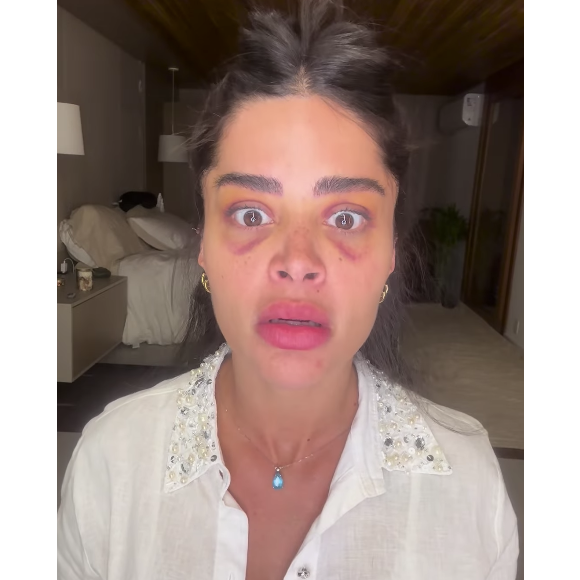 Aline Campos compartilhou um vídeo mostrando o olho roxo resultante de um procedimento estético feito recentemente