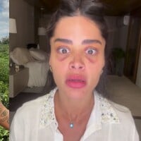 Ex de Jesus Luz, Aline Campos surge com o olho roxo após transplante de sobrancelhas e divide opiniões: 'O que mais faltam inventar?'