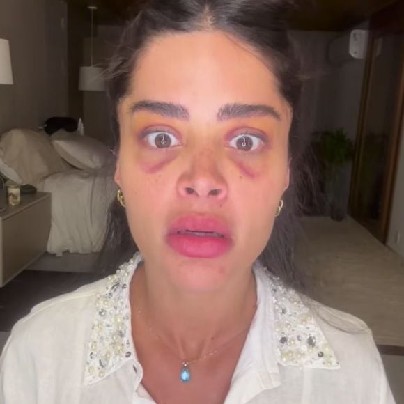 Aline Campos impressiona ao mostrar hematomas de procedimento nas sobrancelhas e vira alvo de críticas