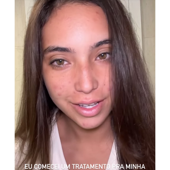 Vanessa Lopes usou suas redes sociais no último domingo (25) para assumir problemas com acne