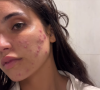 Segundo Vanessa Lopes, os problemas com a acne surgiram devido a uma reação alérgica