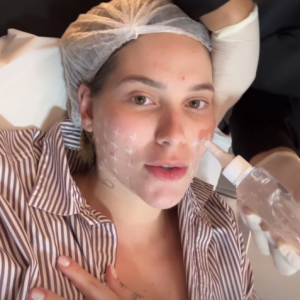 Virgínia Fonseca também fez o procedimento no rosto para combater a flacidez facial e estimular colágeno