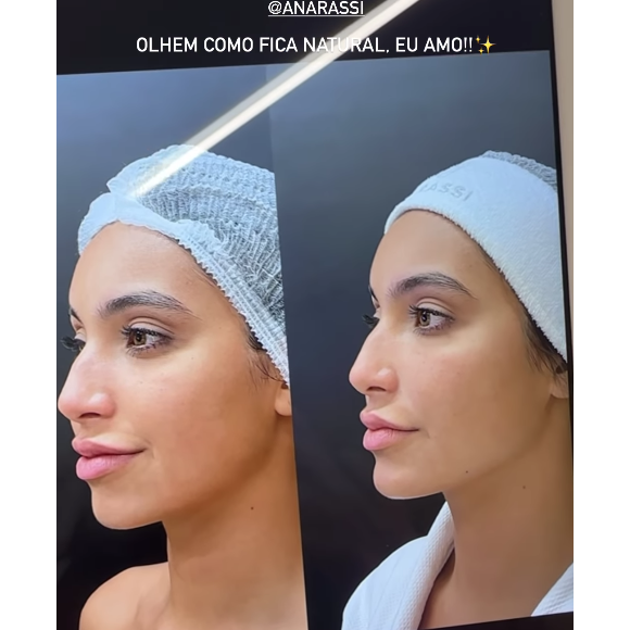 Vanessa Lopes melhorou as olheiras, bigode chinês e colocou um 'ponto de luz' para destacar o queixo