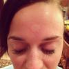 Kate Perry mostra picada de mosquito em seu perfil no Instagram