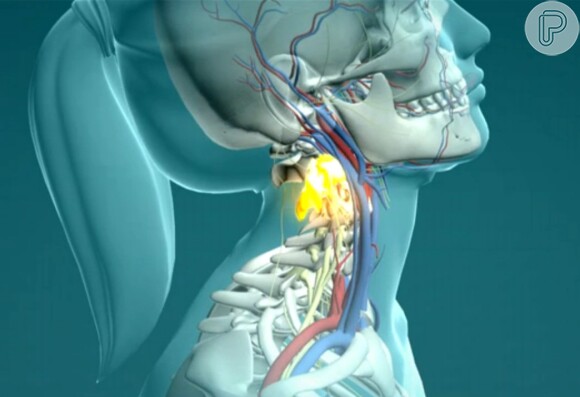 No choque, Lais deslocou a parte entre a terceira e a quarta vértebras, esmagando a medula de maneira gravíssima