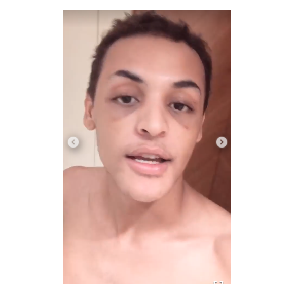 Pabllo Vittar mostrou o resultado da cirurgia em vídeo sem maquiagem e sem estar montada