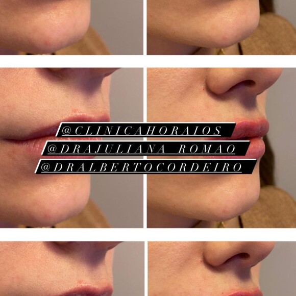 Jade Magalhães fez preenchimento labial e mostrou resultado em foto