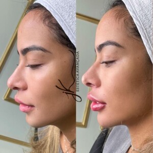 Rafaella Santos retoca harmonização facial