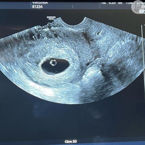 Virgínia Fonseca grávida de um menino? 71% dos seguidores da influencer acham que sim! Veja foto da primeira ultrassom do bebê, realizada em março