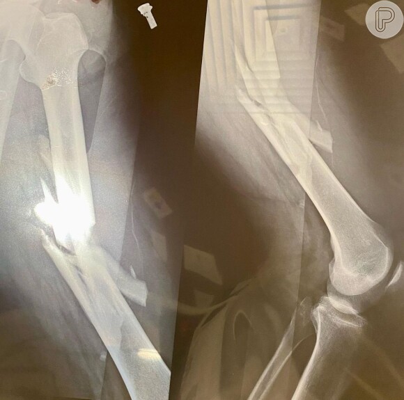 Marcos Breda postou fotos e exames de raio-X após acidente de moto em rua do Rio de Janeiro