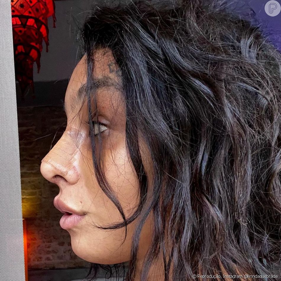 Rinoplastia é uma das cirurgias possíveis para quem passa pelo processo de feminização facial