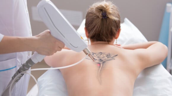 Especialista esclarece dúvidas sobre remoção de tatuagem e dá dicas para evitar arrependimentos futuros