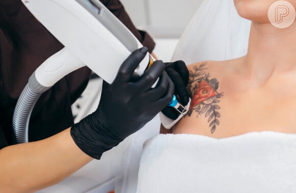 As tatuagens são quase sempre removidas com lasers