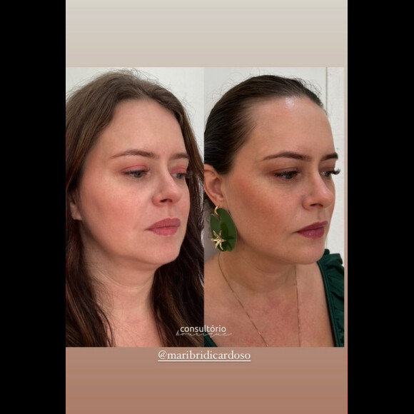 Mari Bridi passou por um procedimento, que impressionou sua dermatologista