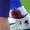 Neymar deixa jogo com tornozelo sangrando em partida do Barcelona