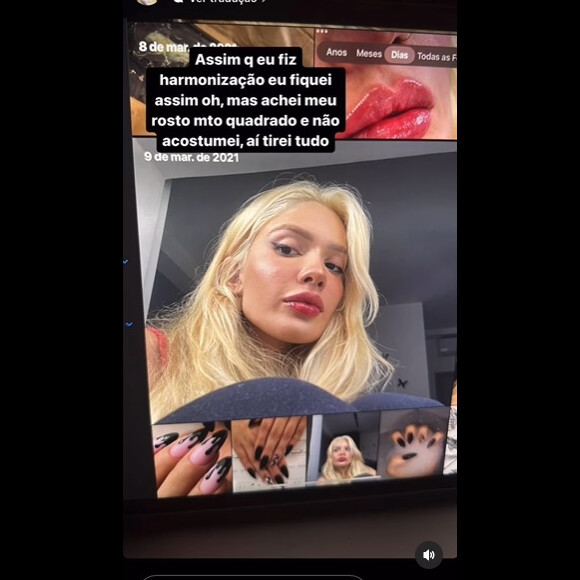 Karoline Lima retirou uma harmonização facial que fez pois não se acostumou com o resultado