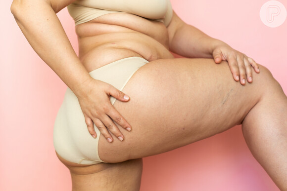 O lipedema não atinge apenas mulheres com obesidade e sobrepeso, indica médica