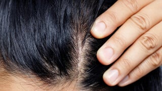 Seu couro cabeludo também precisa de proteção solar! Saiba como diminuir os danos do sol