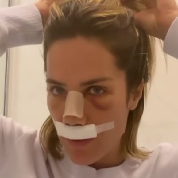 Rinoplastia de Giovanna Ewbank: apresentadora registrou todas as fases da sua recuperação da cirurgia no nariz e compartilhou depois do período de repouso com os fãs em vlog postado em 22 de agosto de 2023 no seu canal do YouTube